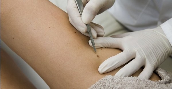 В Брестской области ежегодно регистрируется более 1 тыс. случаев злокачественных новообразований кожи