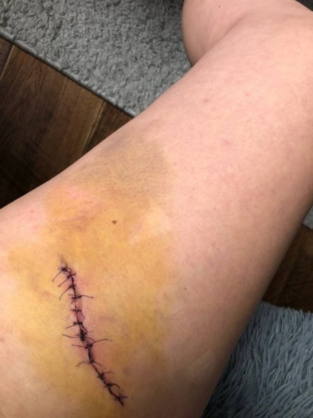 «Как итог — у меня изувечена нога». Девушка пошла на квест и получила травму