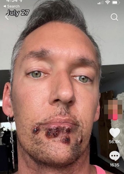 Что делает оспа обезьян с лицом. Фото пациентов