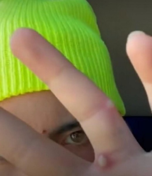 Что делает оспа обезьян с лицом. Фото пациентов