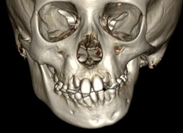 В стране впервые провели операцию пациентке с синдромом Гольденхара. Рассказываем, что это за болезнь