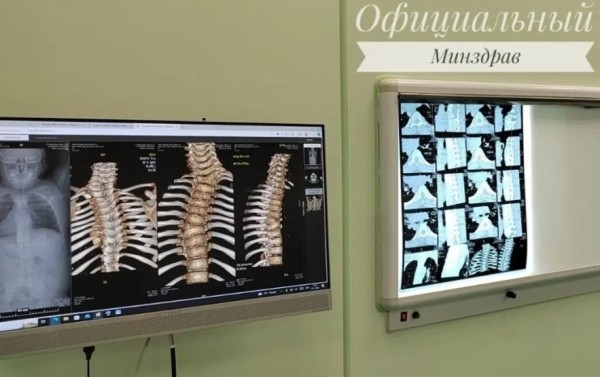 В Беларуси сделали операцию ребенку с врожденной аномалией позвоночника